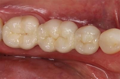 Zahnbrücke im Mund, die fehlende Zähne durch künstliche ersetzt, deren Farbe an die umgebenden Zähne angepasst ist.