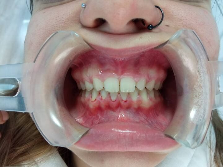 Un primer plano de la boca de una mujer con un protector bucal transparente.