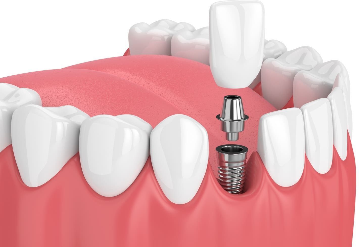 Un primer plano de un diente con un implante dental.