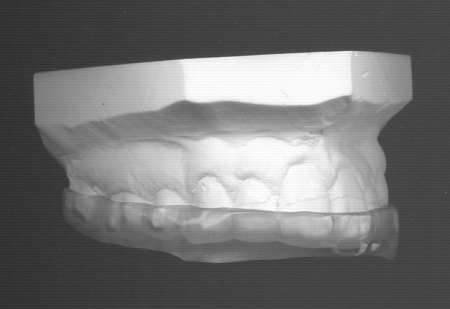 gouttière dentision