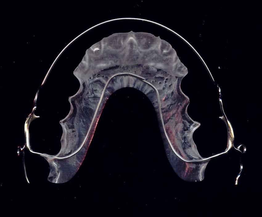 Contention dentision