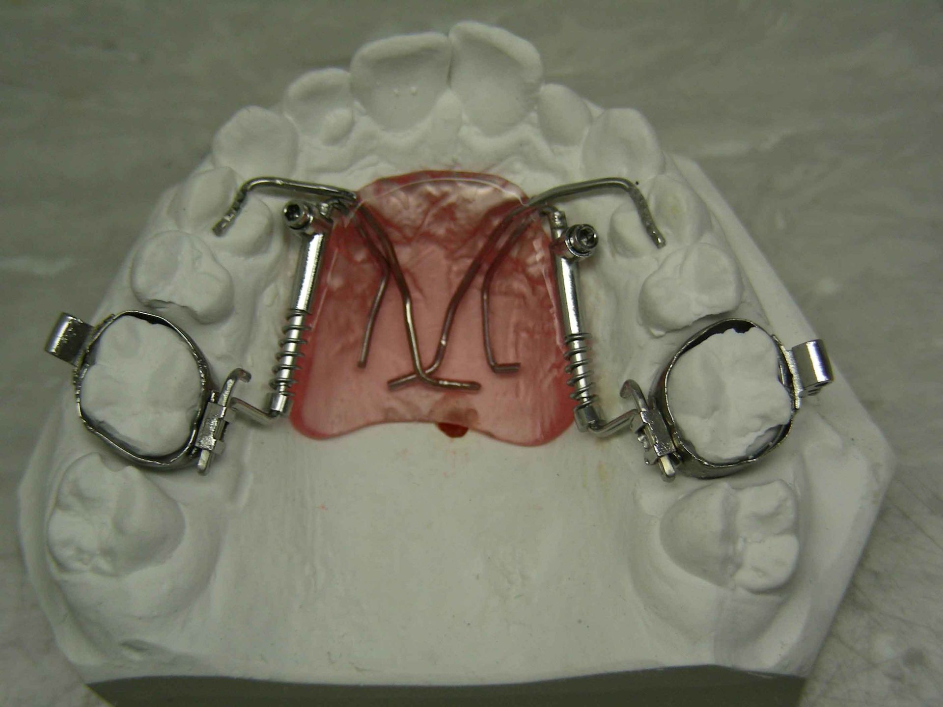 Distal-jet Dentision