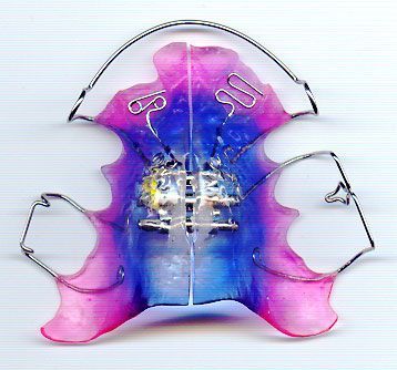 appareils-orthodontiques-dentision