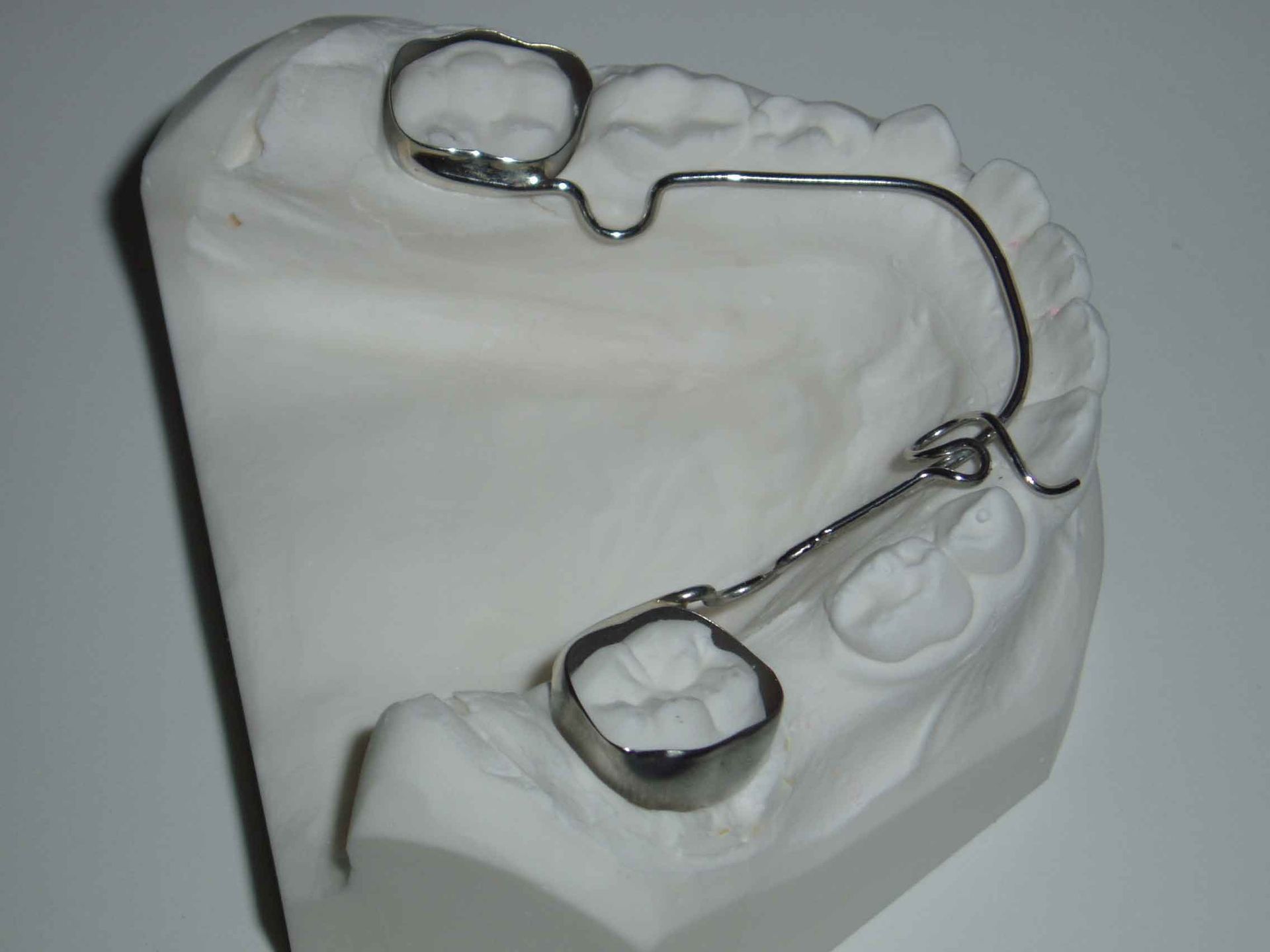 arc-lingual-orthodontique-dentision