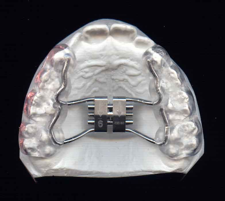 disjoncteur résine dentision