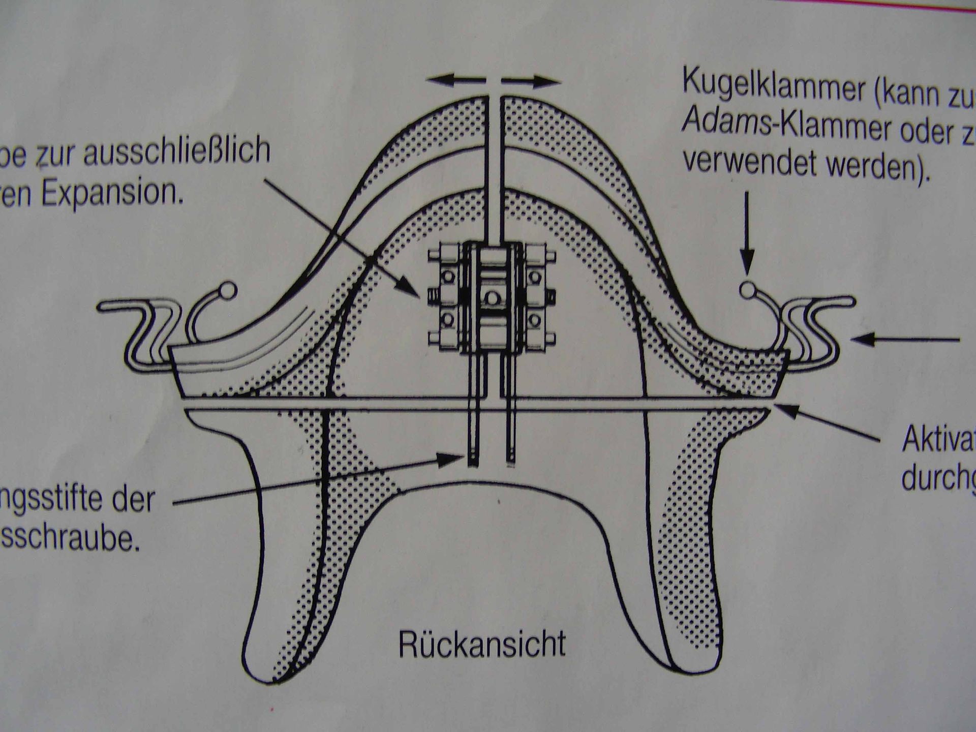 Monobloc vis supérieur