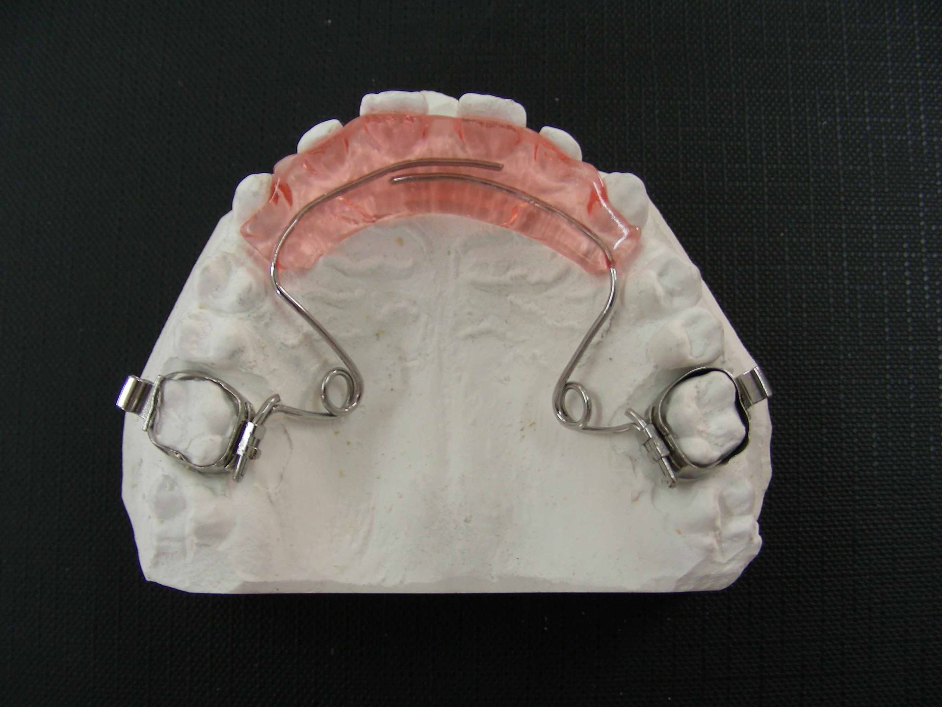 sur-élévation antérieure