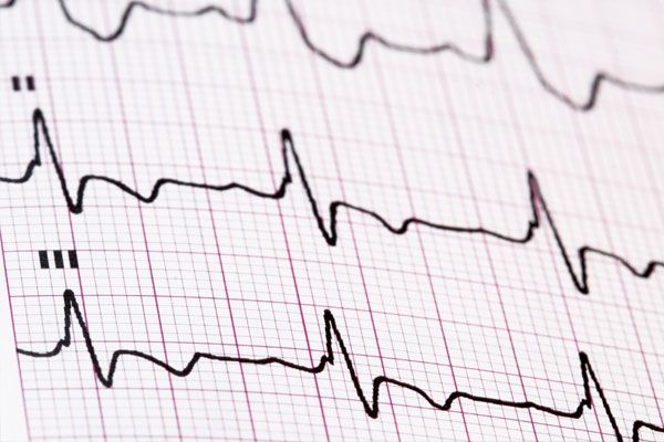 Ηλεκτροκαρδιογράφημα (ΗΚΓ)