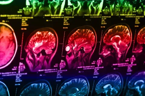 Imágenes de resonancia magnética coloridas de un cerebro en varias secciones sagitales.