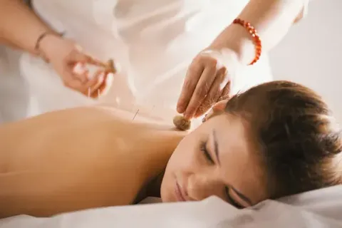 Mujer recibiendo acupuntura en la espalda. El terapeuta le coloca agujas con moxa.