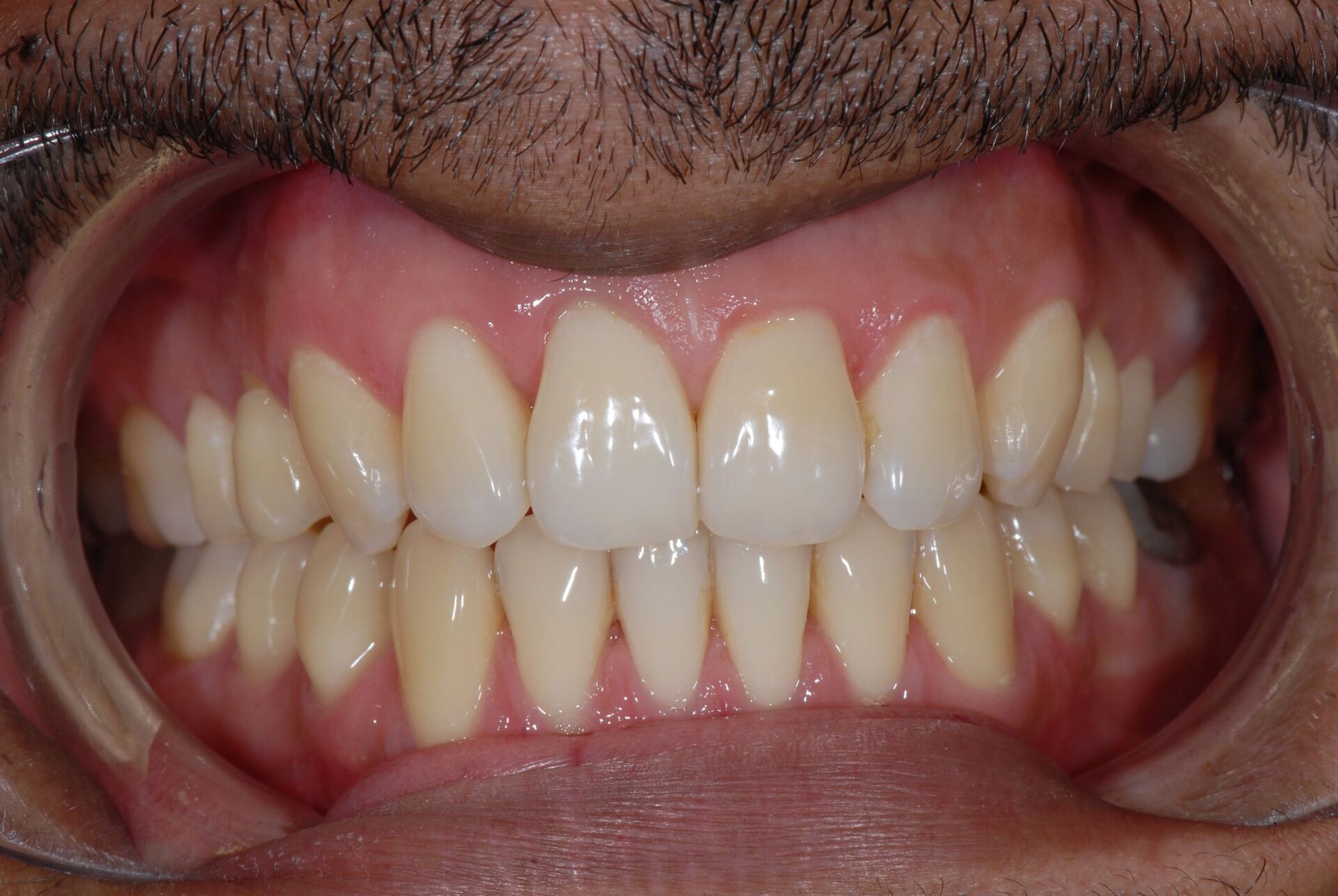 Un alignement incisive après