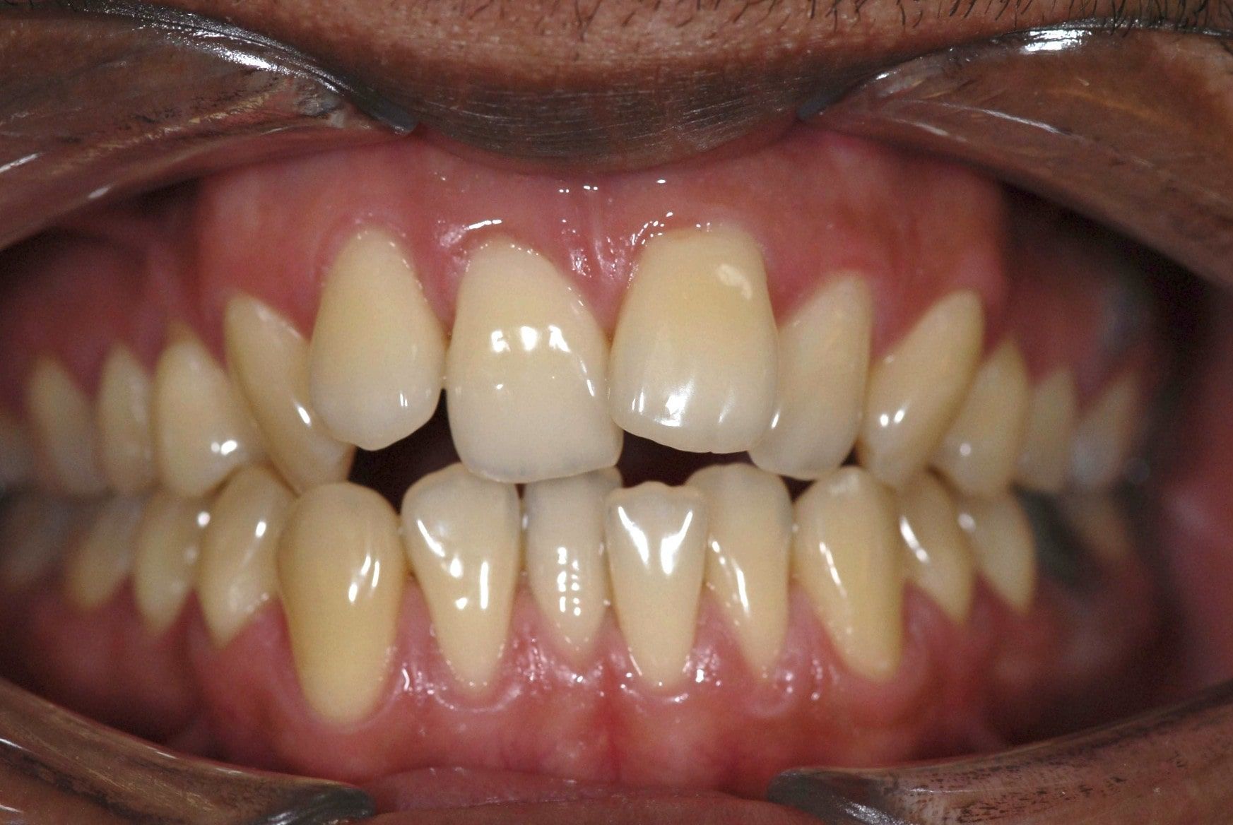 Un alignement incisive avant