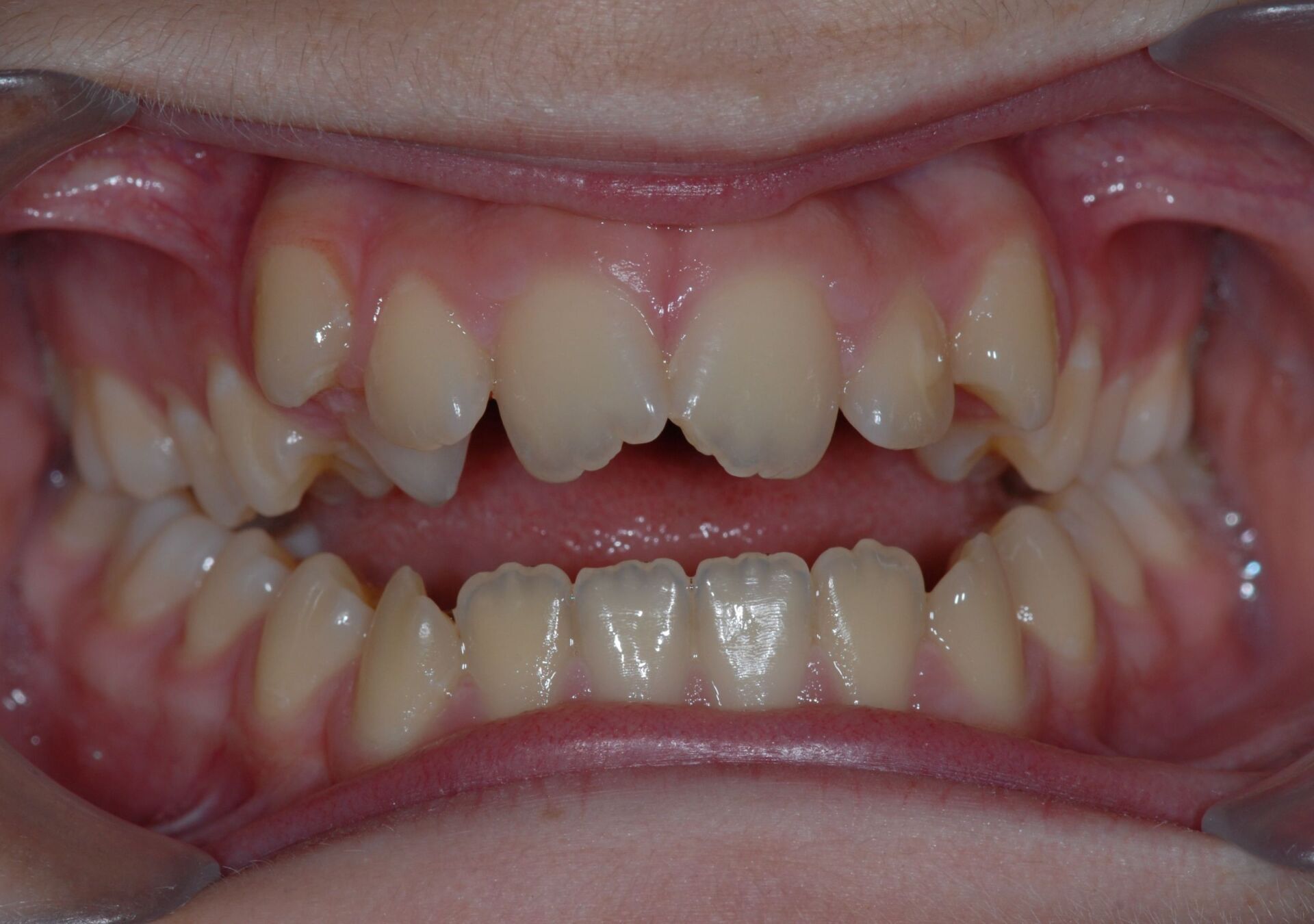 Une béance avec mâchoire étroite avant