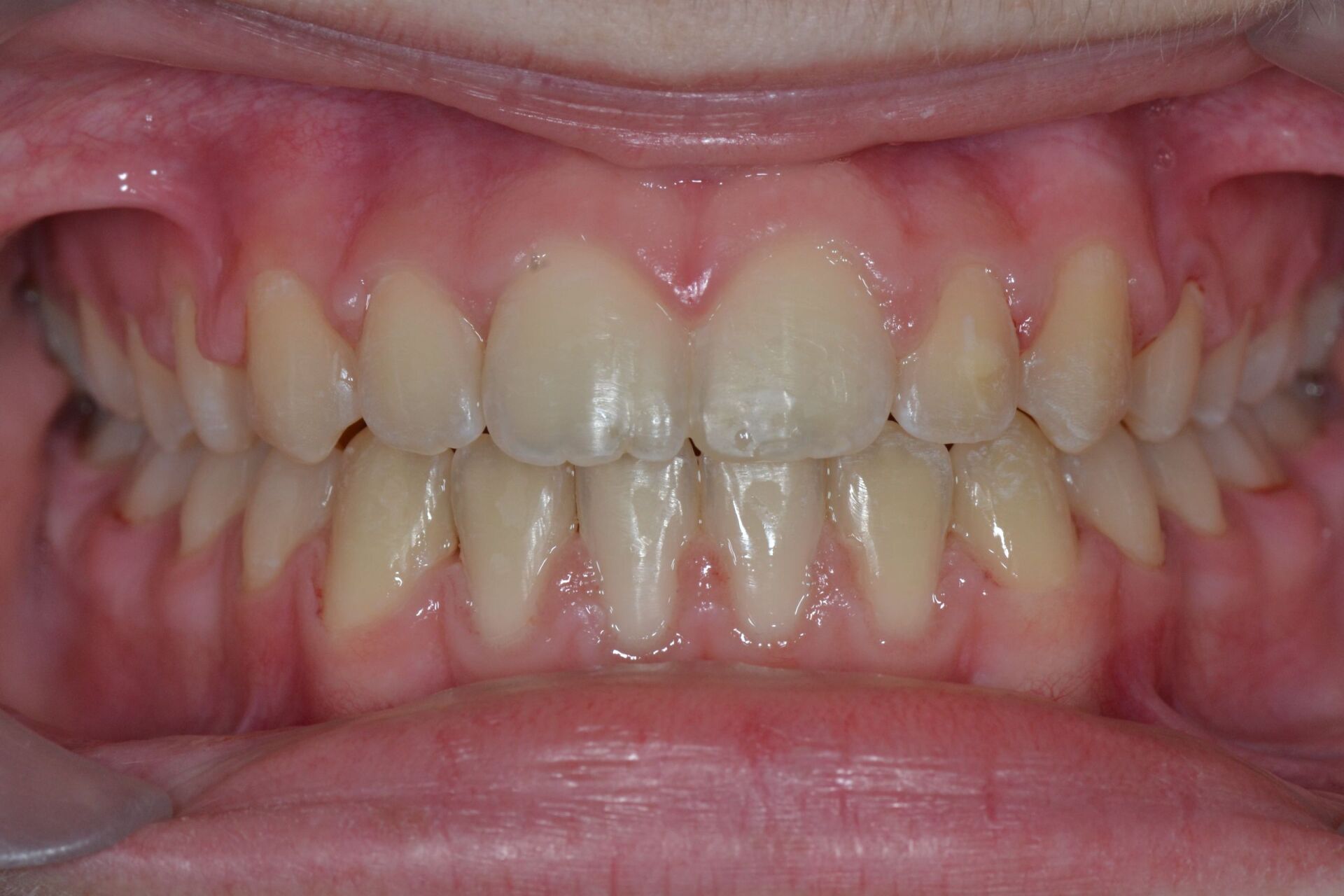 Une béance avec mâchoire étroite après