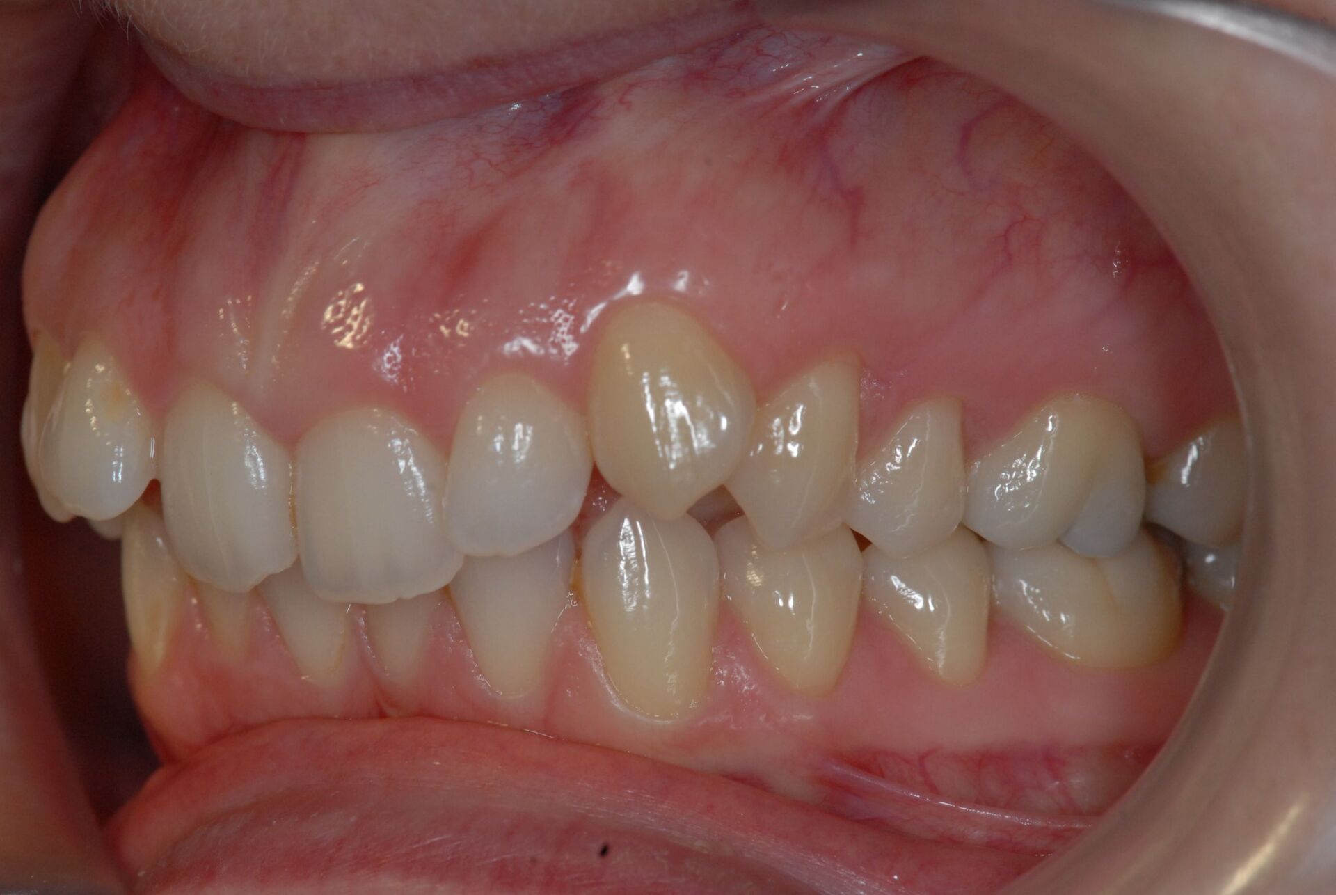 Traitement avec extraction de prémolaires avant