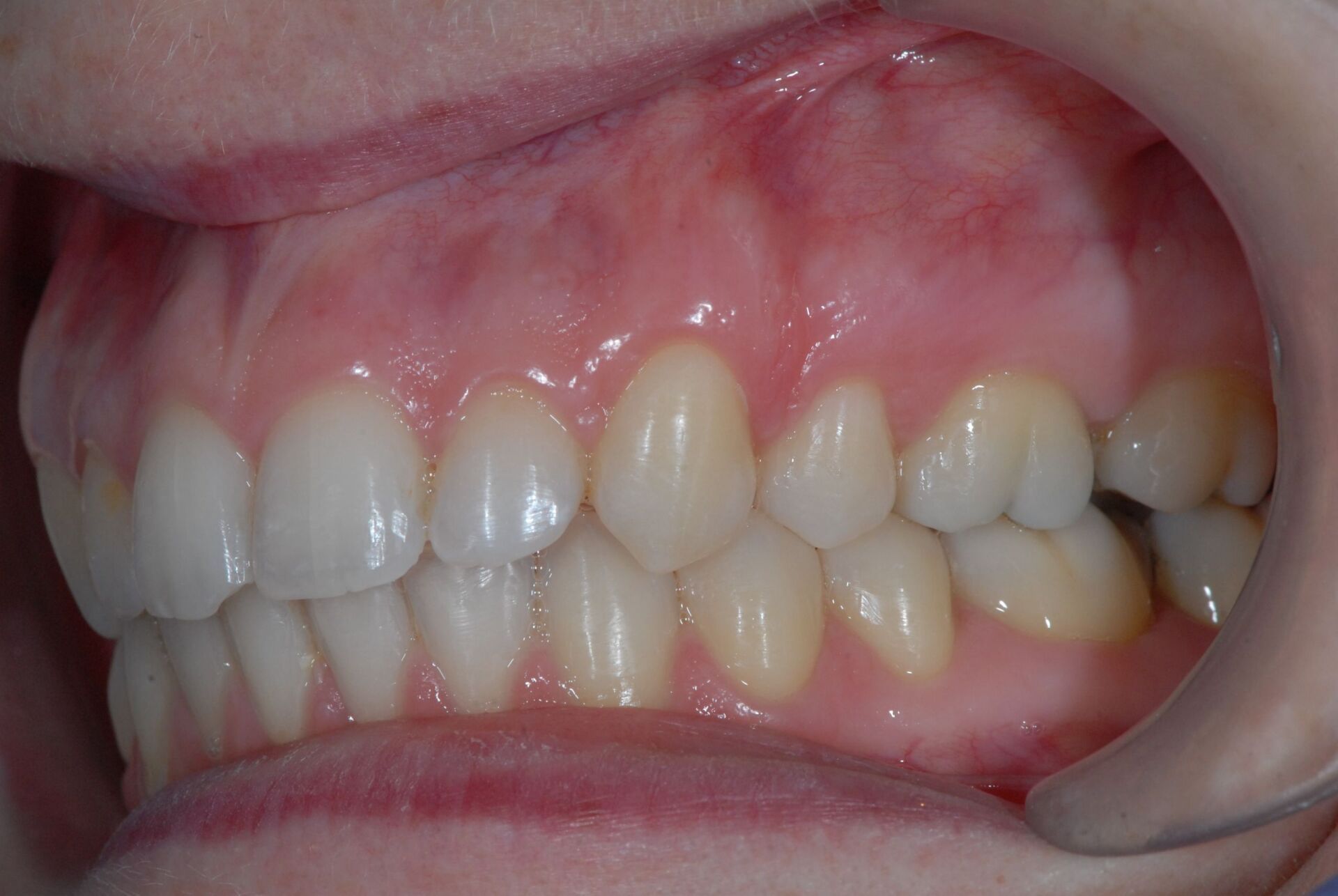 Traitement avec extraction de prémolaires après