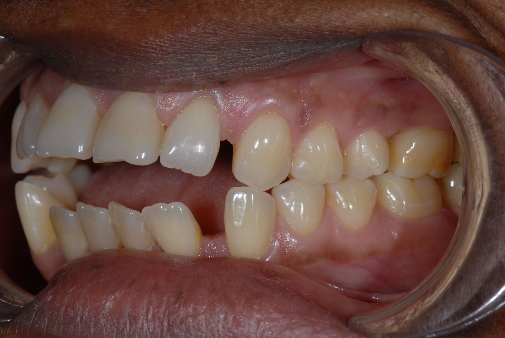 Une béance antérieure avec version incisives avant