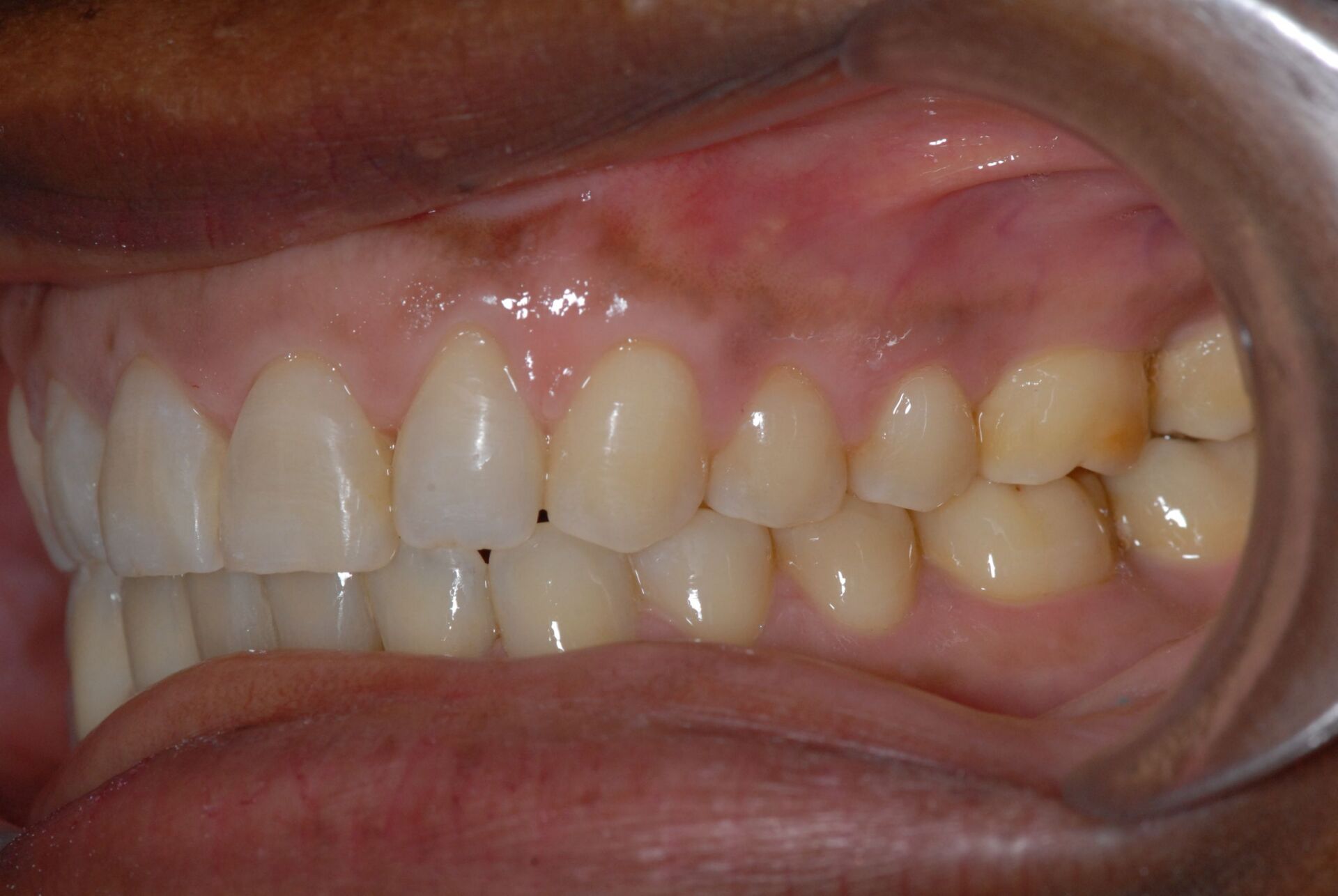 Une béance antérieure avec version incisives après