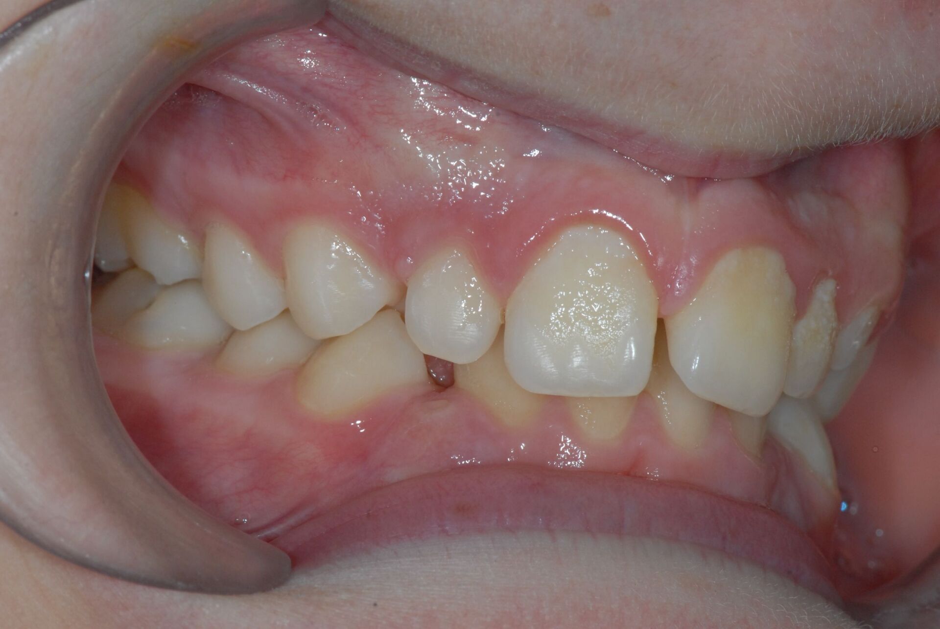 Déblocage de canines sans extraction avant