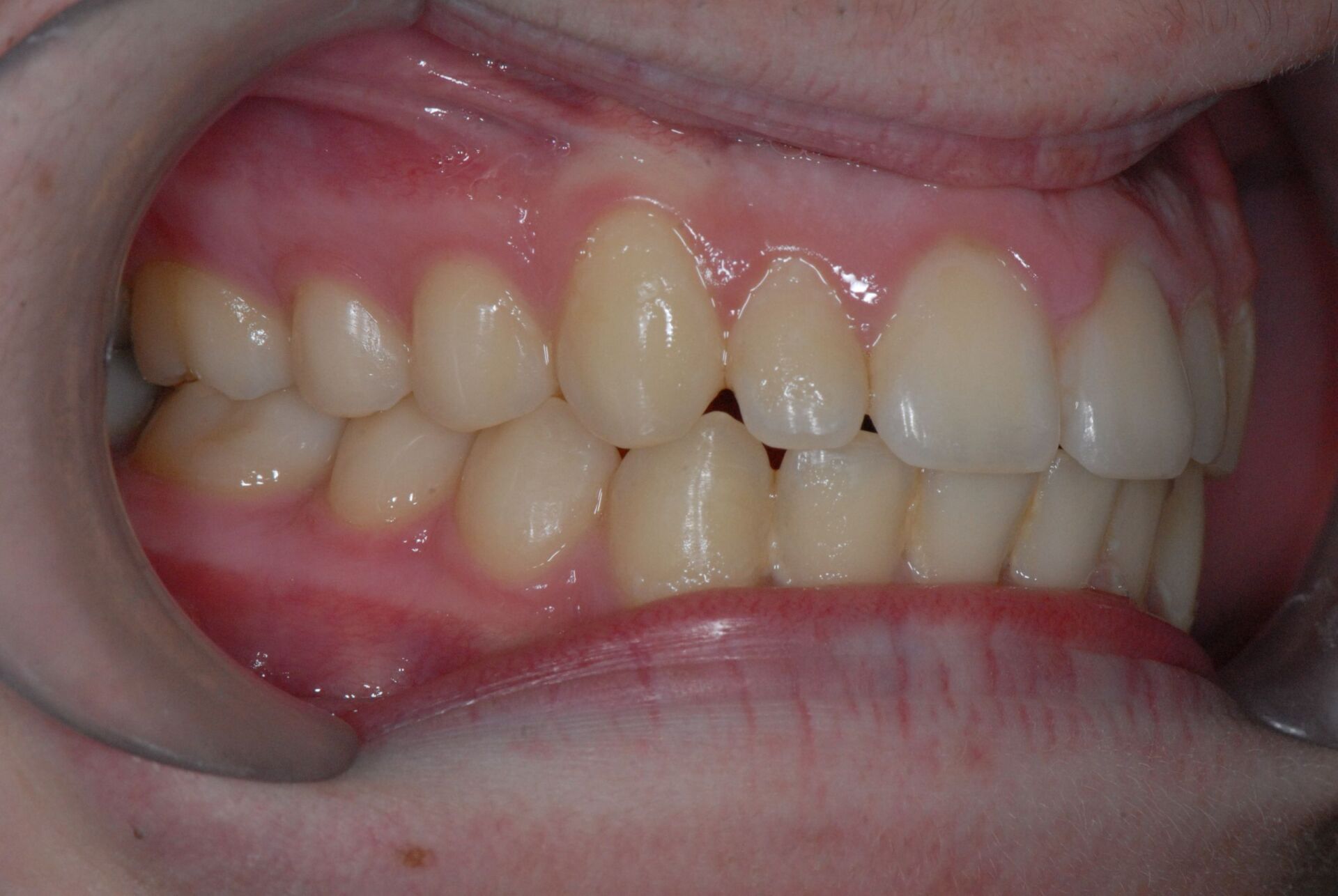 Déblocage de canines sans extraction après