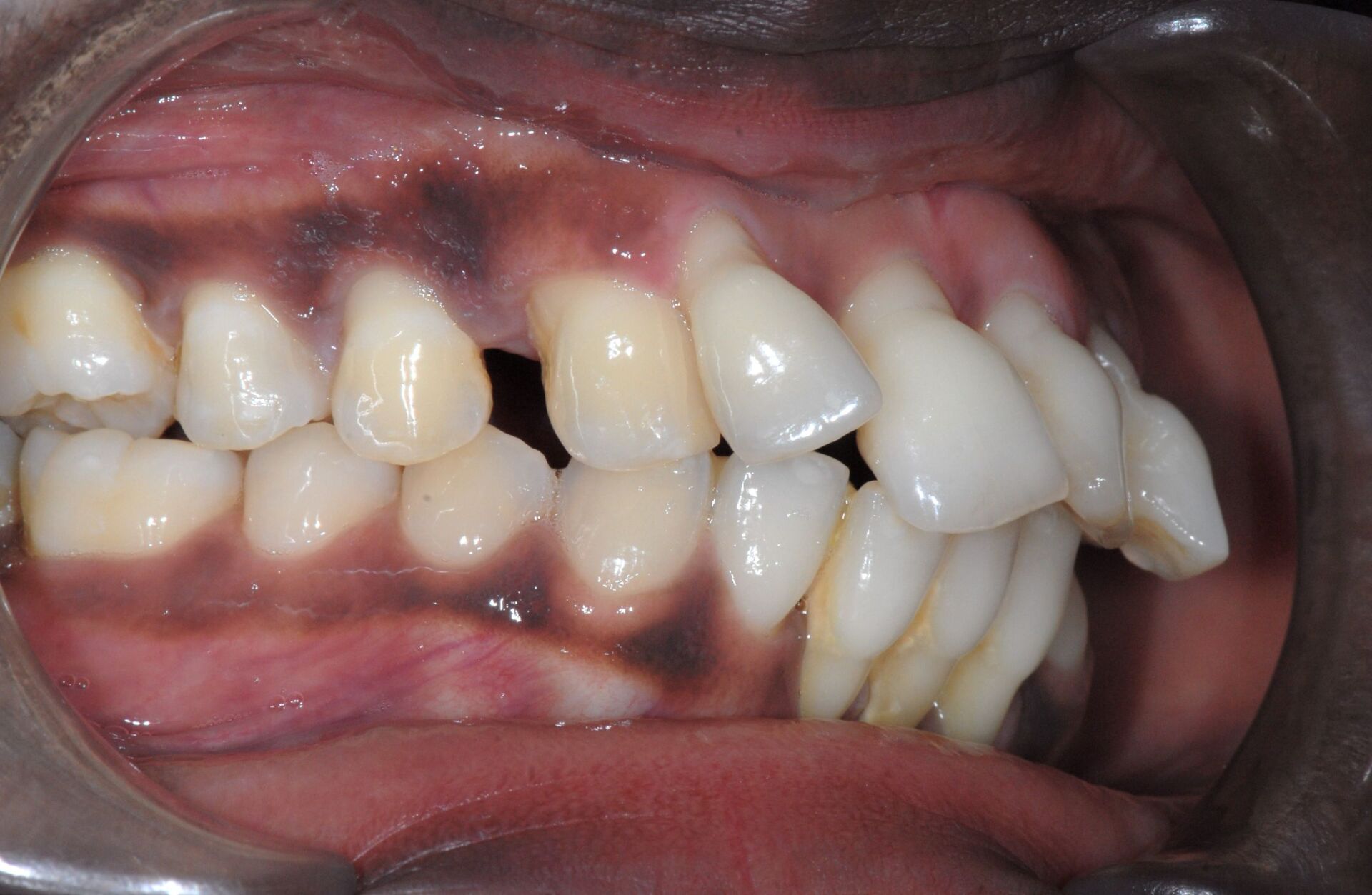 Rattrapage de migrations dentaires dues au déchaussement avant