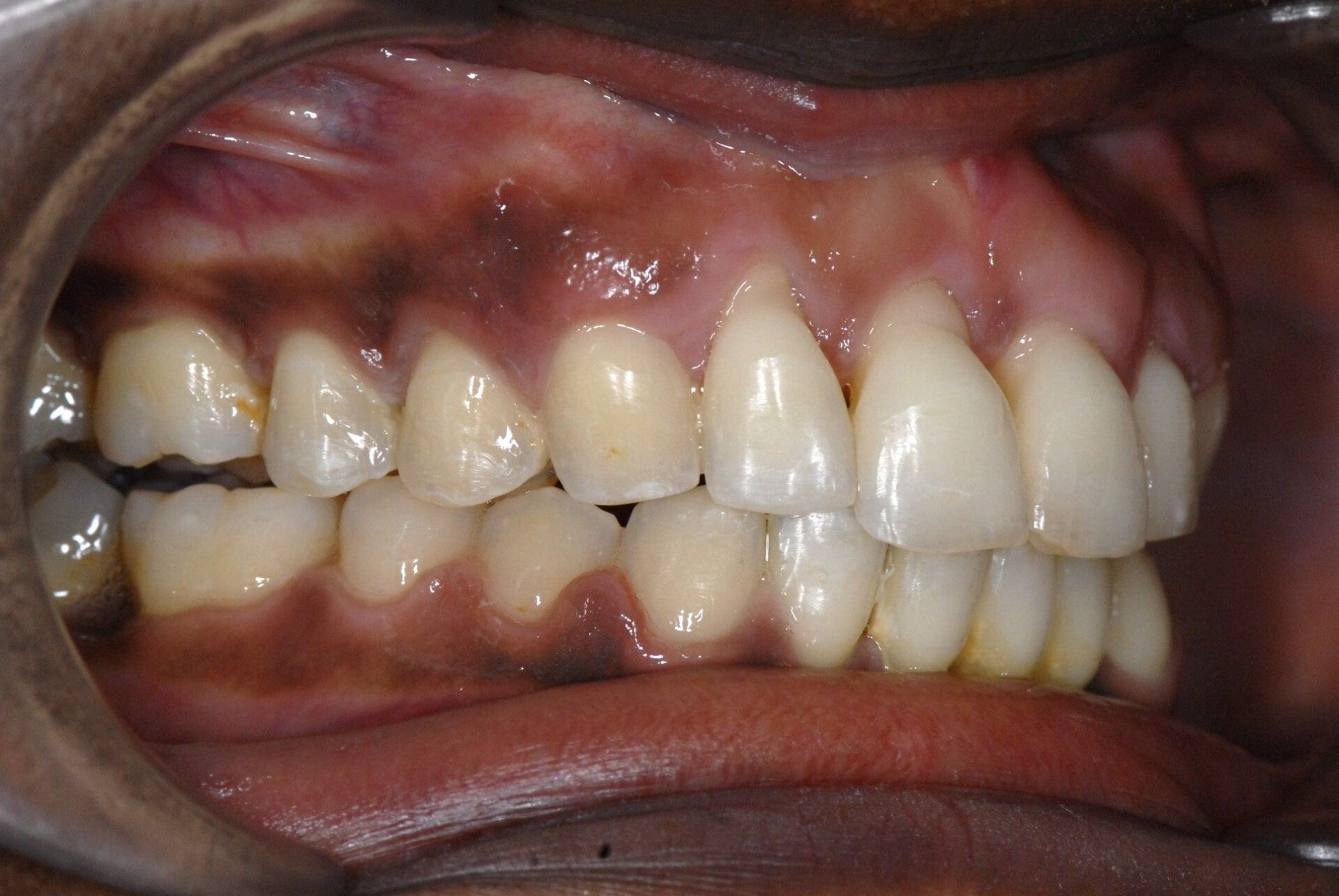 Rattrapage de migrations dentaires dues au déchaussement après