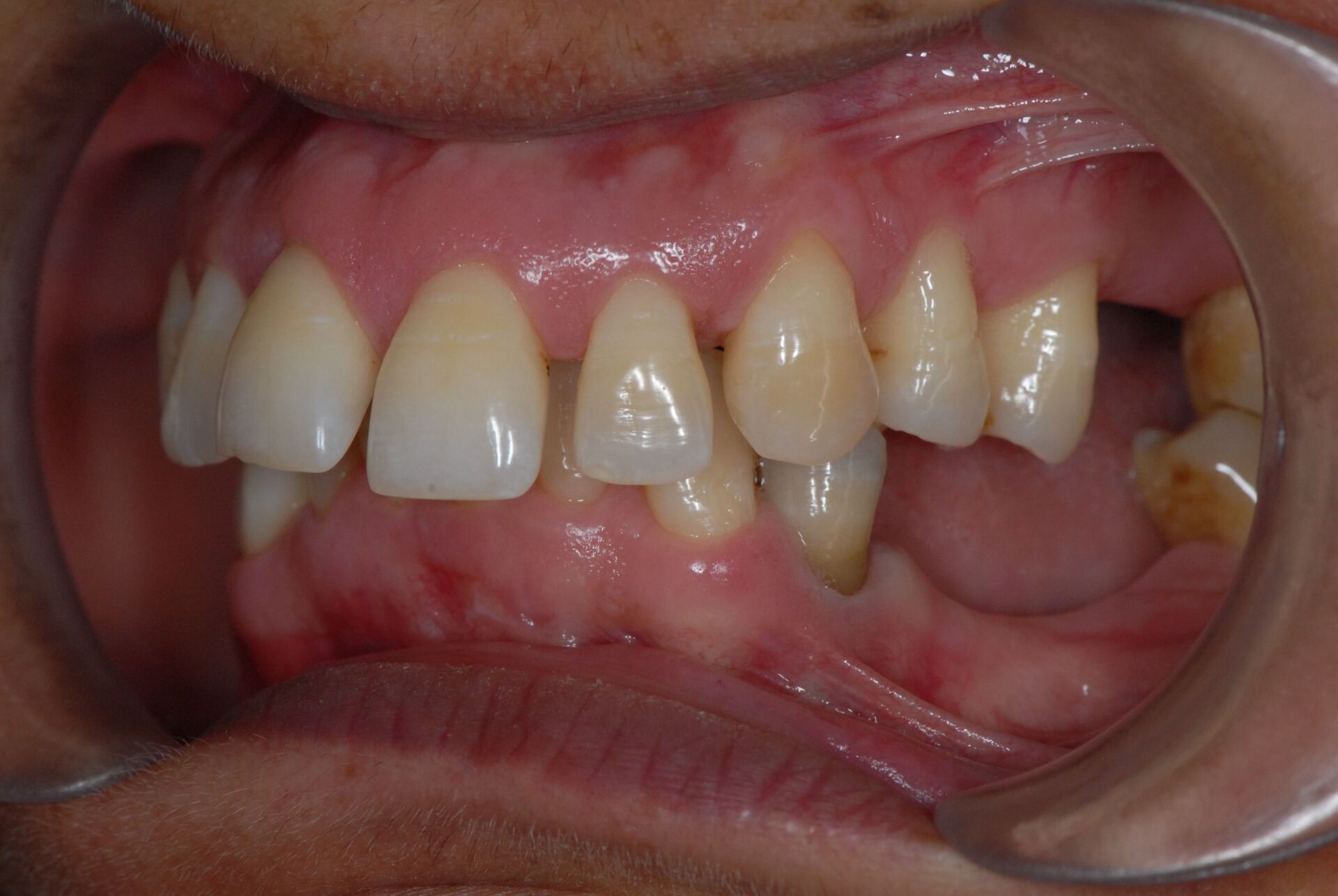 Préparation prothétique avec correction verticale avant