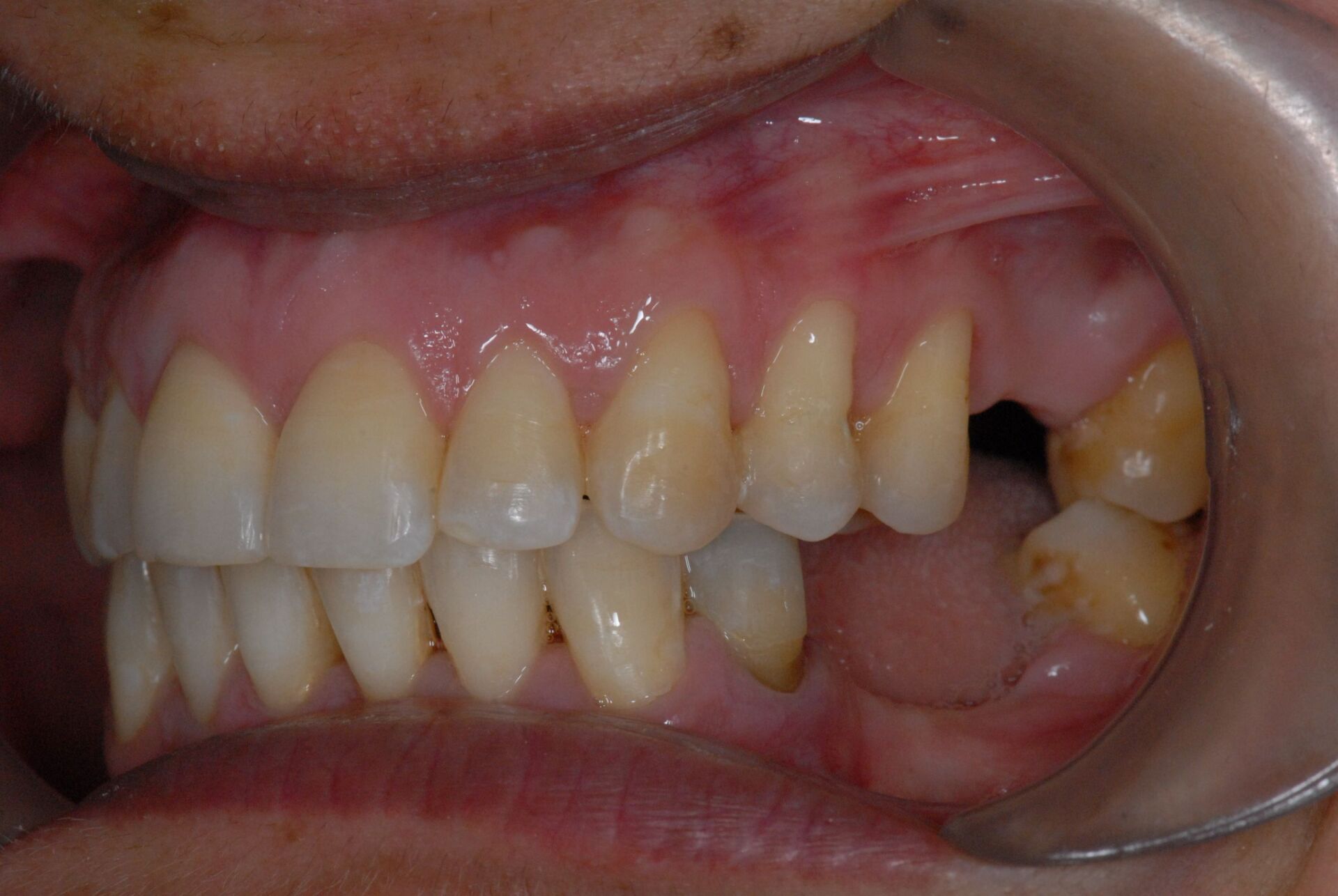 Préparation prothétique avec correction verticale après