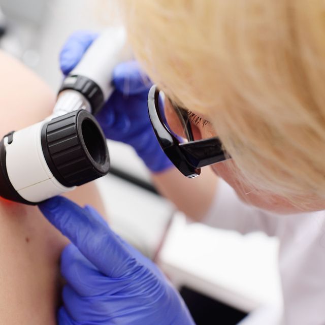Un médico está examinando la piel de un paciente con una lupa.