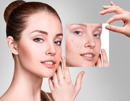 Una mujer sostiene una fotografía de su rostro antes y después del tratamiento del acné.