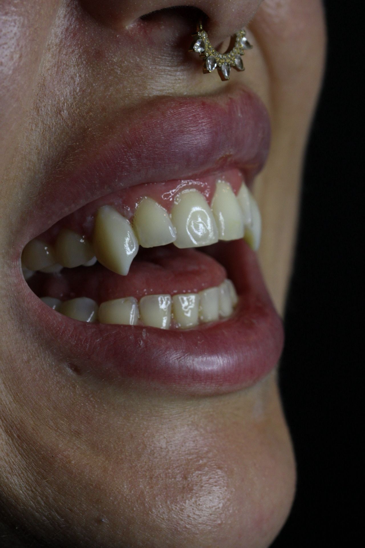 Primer plano de la boca de una persona con un piercing en el labio y dientes visibles sobre un fondo oscuro.