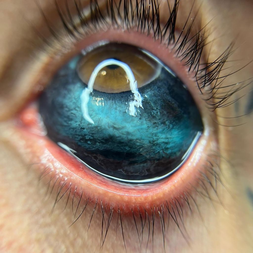 Primer plano de un ojo humano con una lente de contacto reflectante de color azul y pestañas largas.