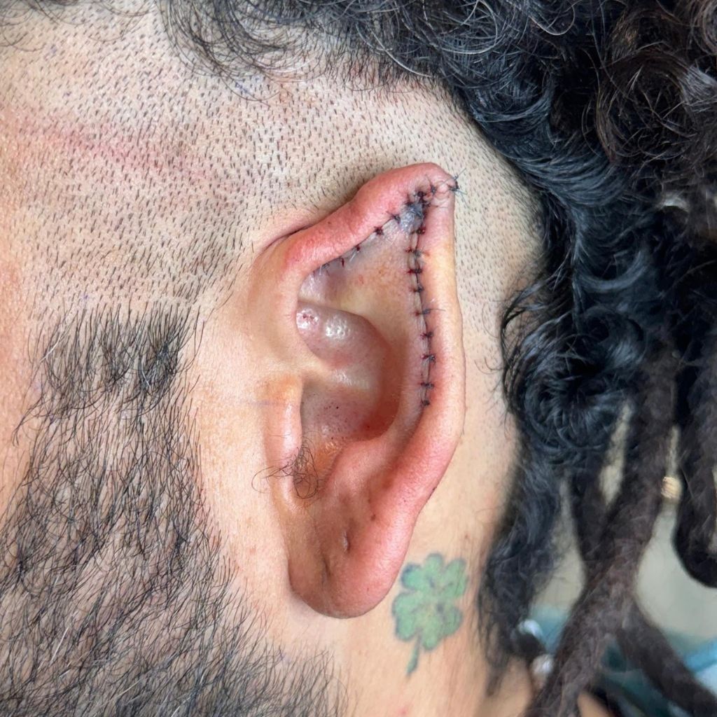 Primer plano de una oreja cosida en la cabeza de una persona con un lado rapado y un pequeño tatuaje verde cerca.