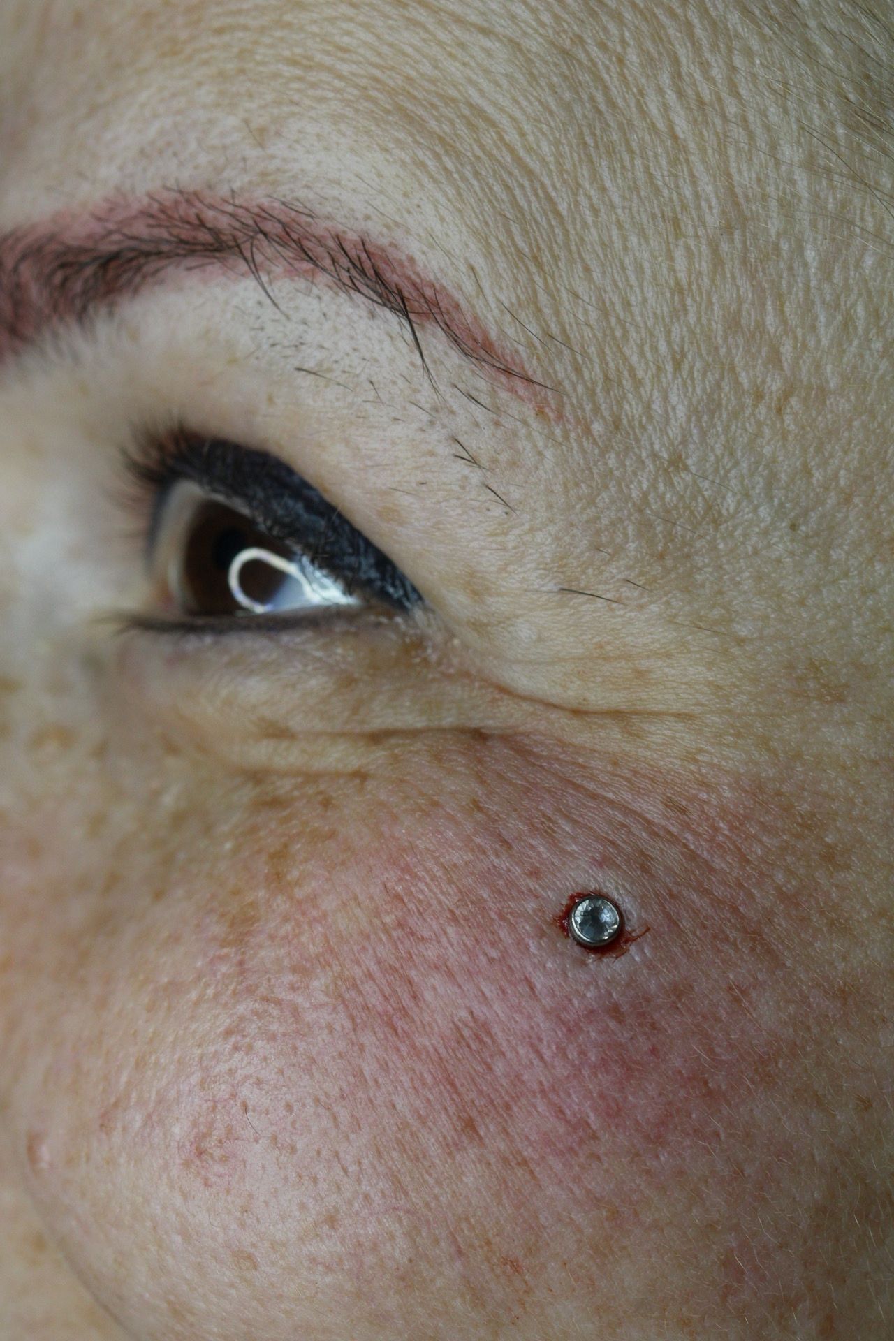 Primer plano de un ojo con un pequeño pendiente en la mejilla, que muestra la piel enrojecida e irritada.