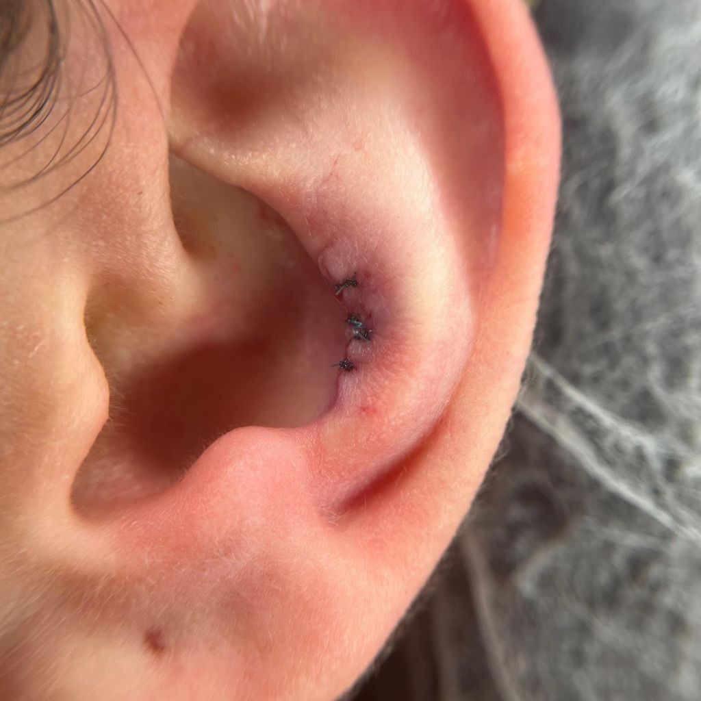 Primer plano de una oreja con una pequeña incisión suturada en el pliegue interno.