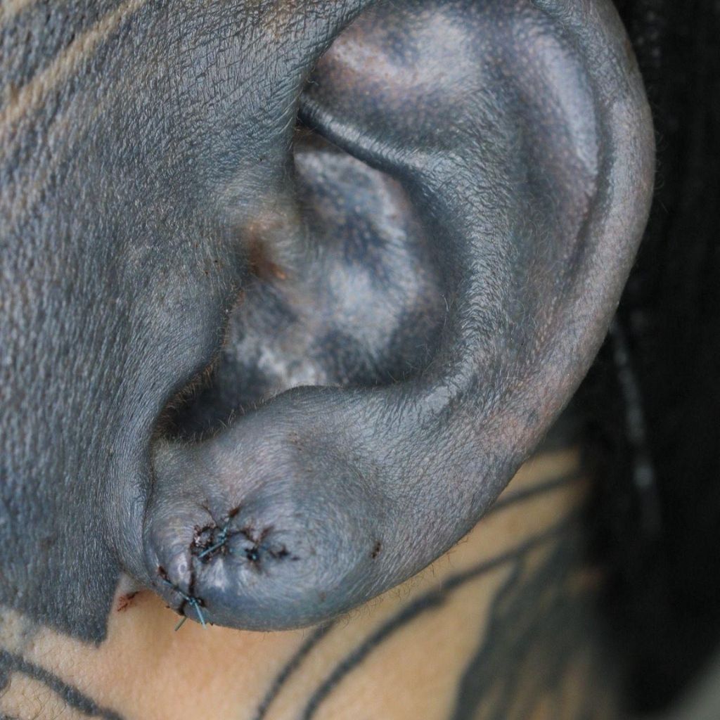 Primer plano de una oreja suturada con una pequeña herida cerca del lóbulo.