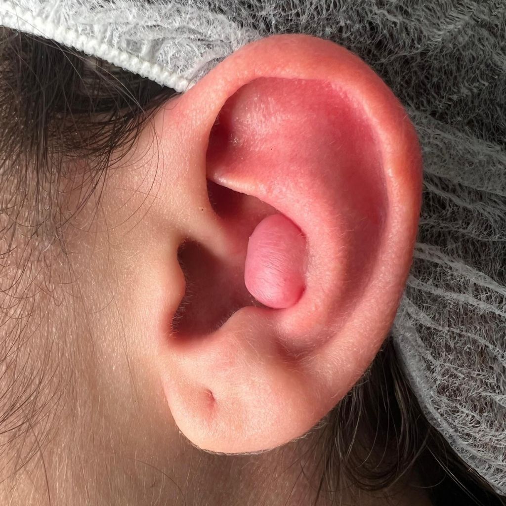 Primer plano de una oreja humana con un pendiente de tapón rosa y una redecilla blanca cerca.