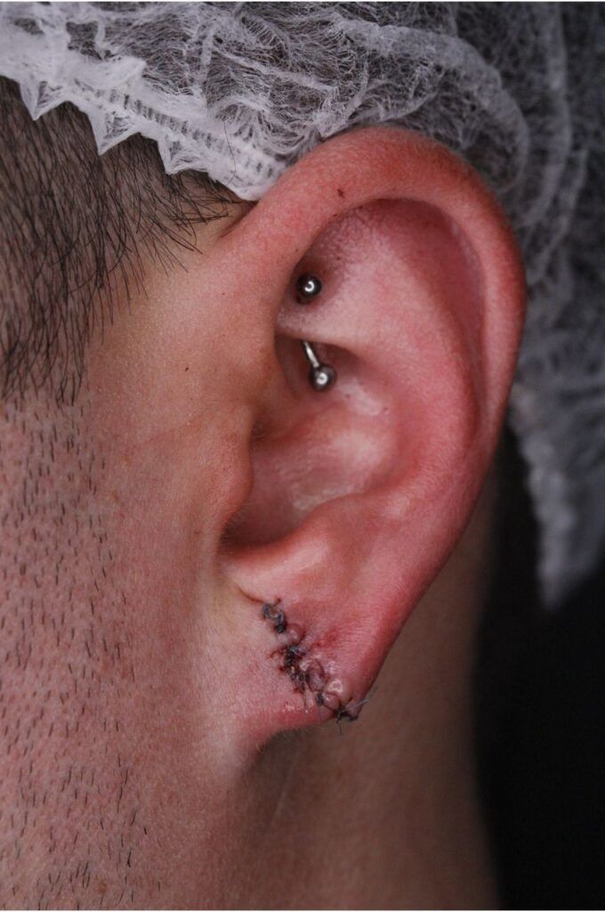 Primer plano de una oreja con un doble piercing en el cartílago y un corte suturado debajo.