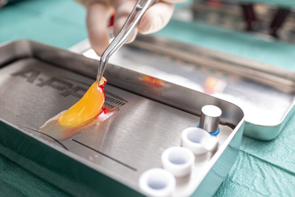 Zahnärztliches Instrument, das eine orangefarbene Zahnabformung auf einer Metallschale mit weißen Kappen hält