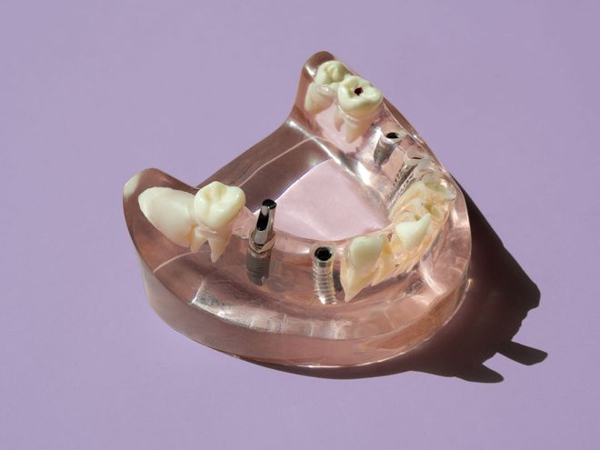 Modelo de implante dental con base de encía transparente y dientes artificiales sobre un fondo morado.