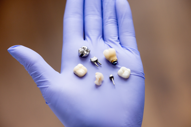 Mano enguantada sosteniendo varios dientes extraídos y coronas dentales sobre un fondo borroso.