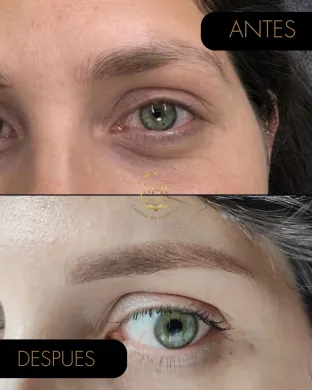 Comparación del antes y el después del tratamiento de las ojeras, que muestra una reducción de las mismas.