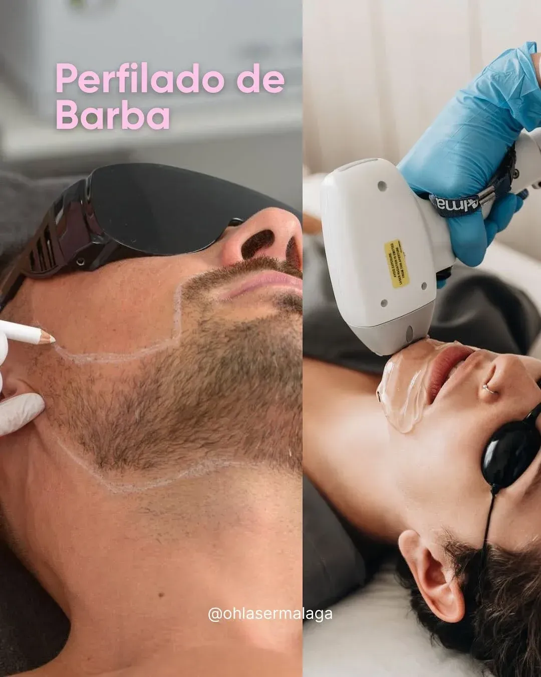 Dos hombres reciben tratamientos de cuidado de barba: uno de perfilado y el otro de depilación láser.