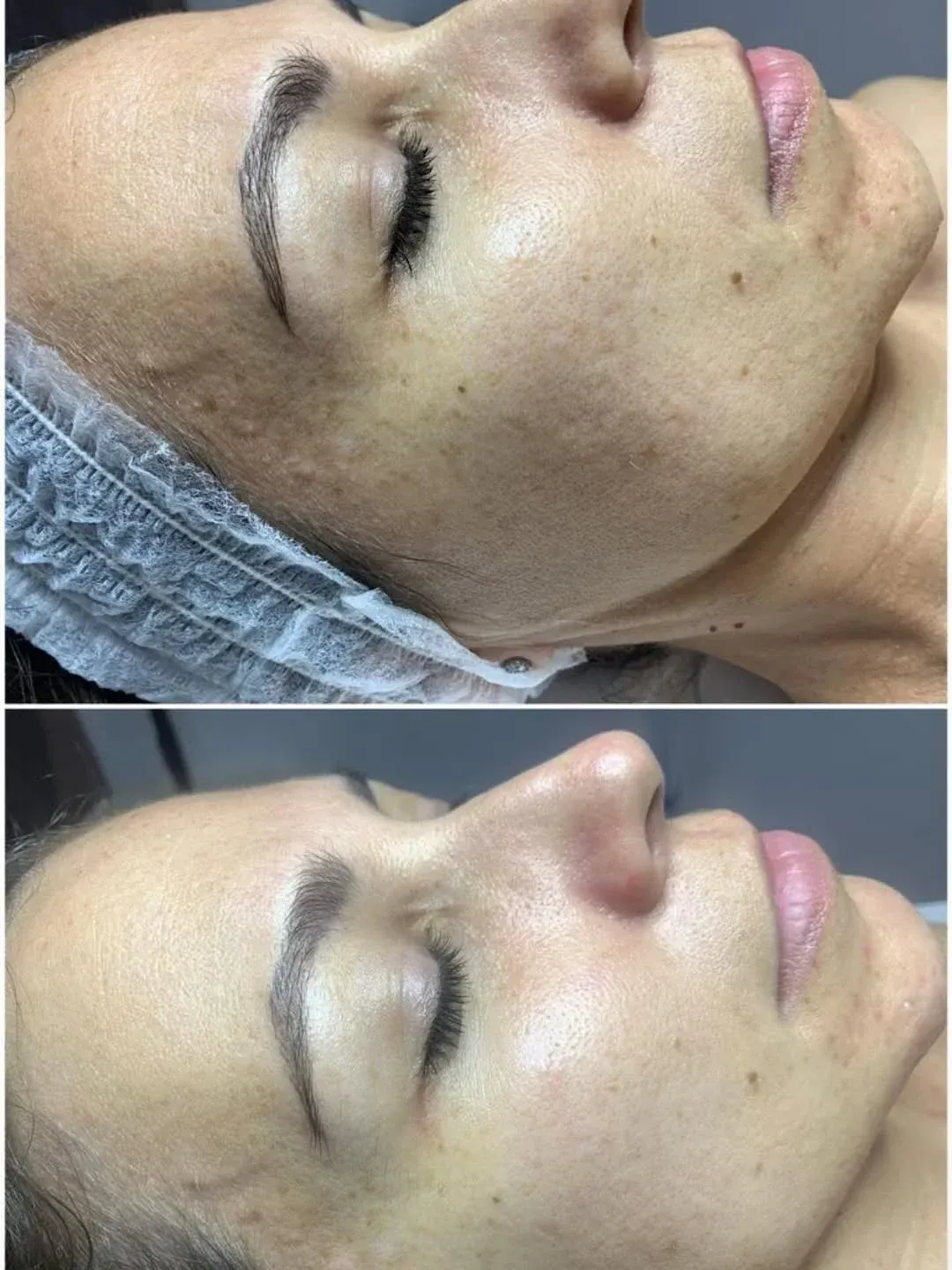 Comparación del rostro de una persona antes y después de un tratamiento de cuidado de la piel.