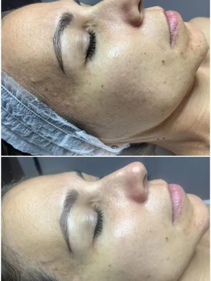 Comparación del rostro de una persona antes y después de un tratamiento de cuidado de la piel.