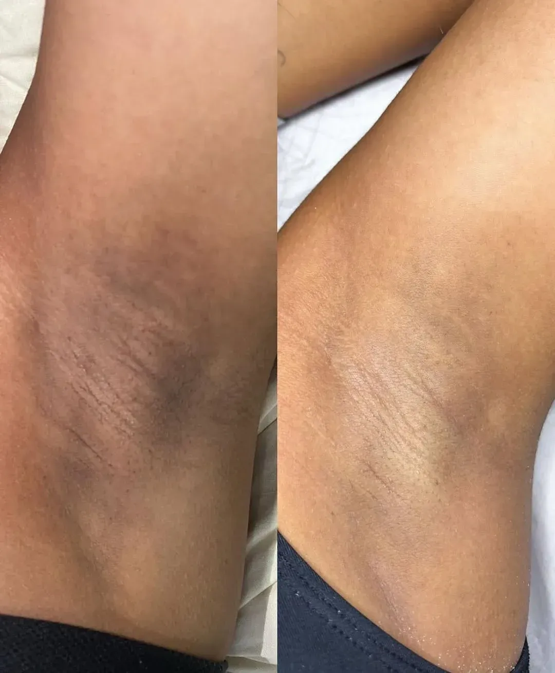 Comparación de axilas oscuras antes y axilas más claras después del tratamiento.