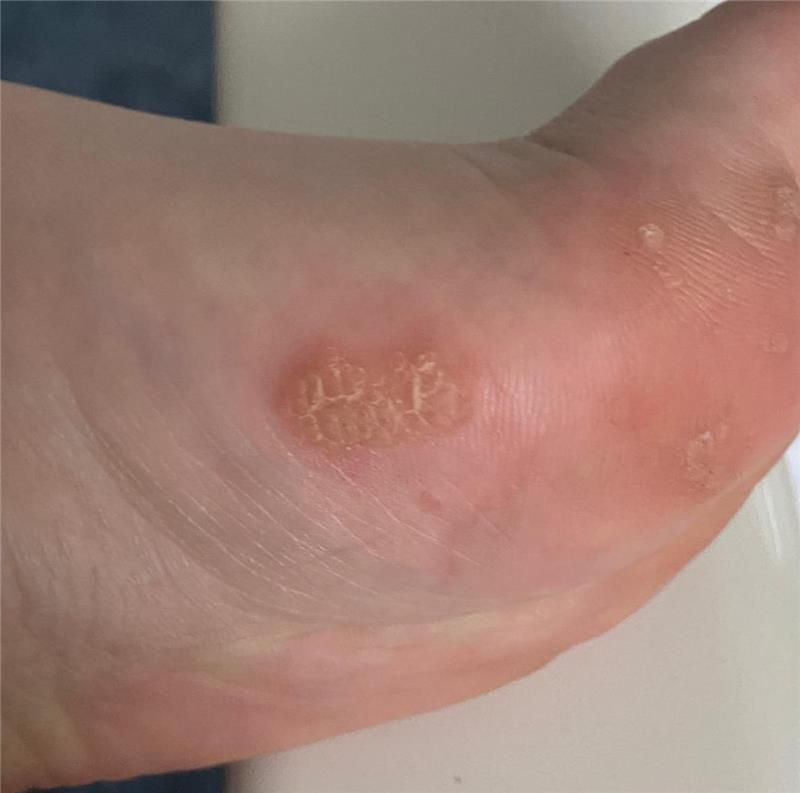 Eine Nahaufnahme des Fußes einer Person mit einer Warze.