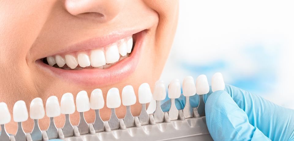 blanchiment dentaire