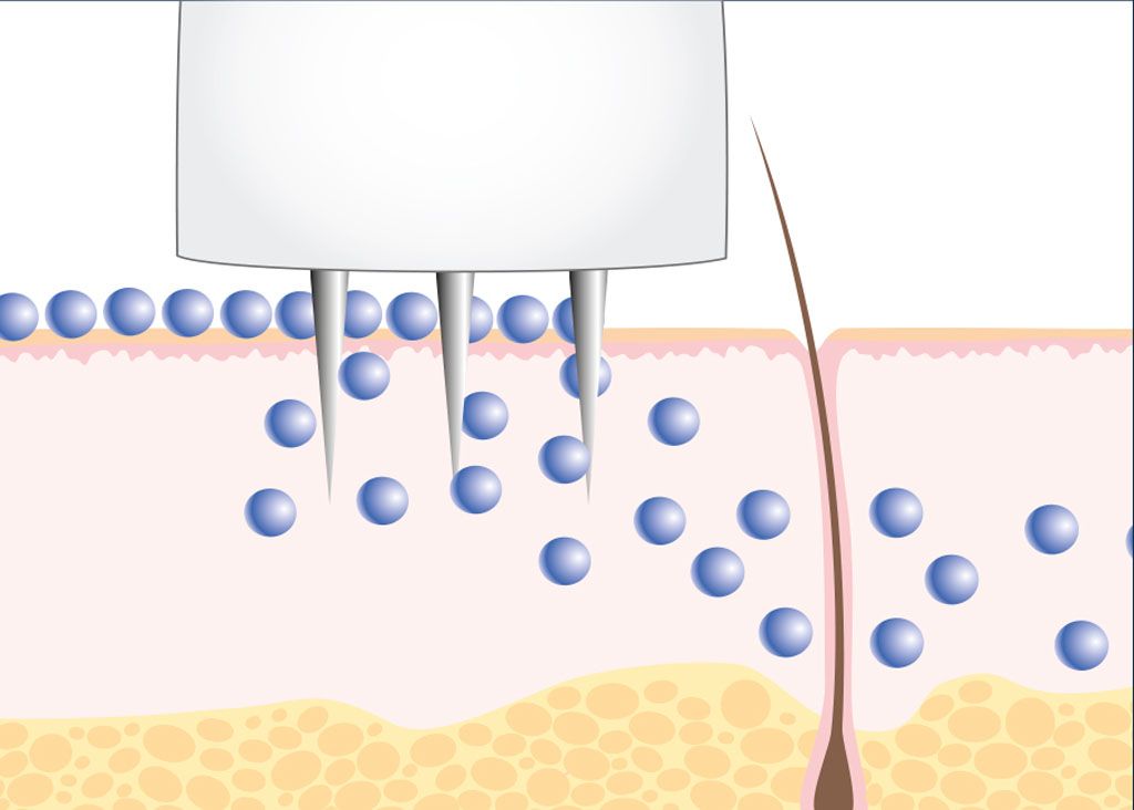Microneedling - Cosmetic Les Belles - Abtwil SG