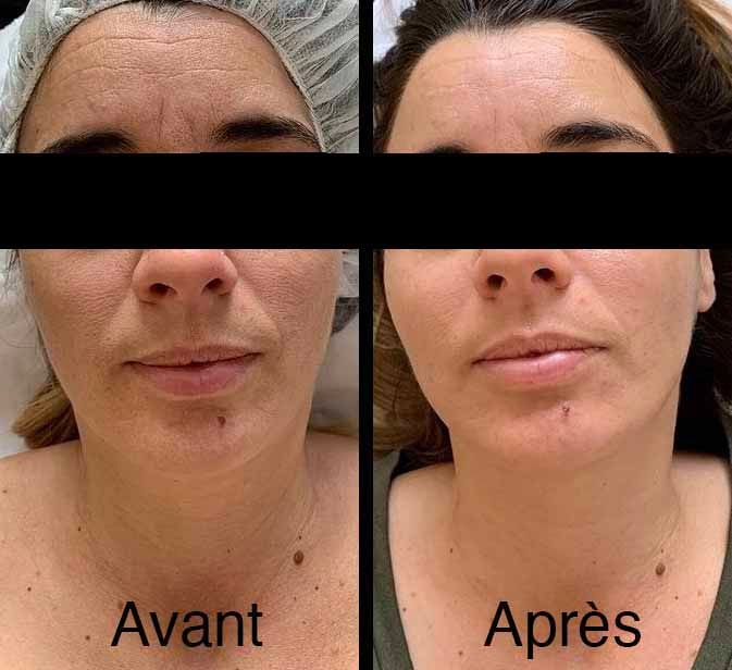 Comparaison côte à côte du visage d'une personne. À gauche montre des rides ; à droite paraît plus lisse.